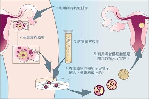 胚胎移植后侧卧可导致宫外孕的发生